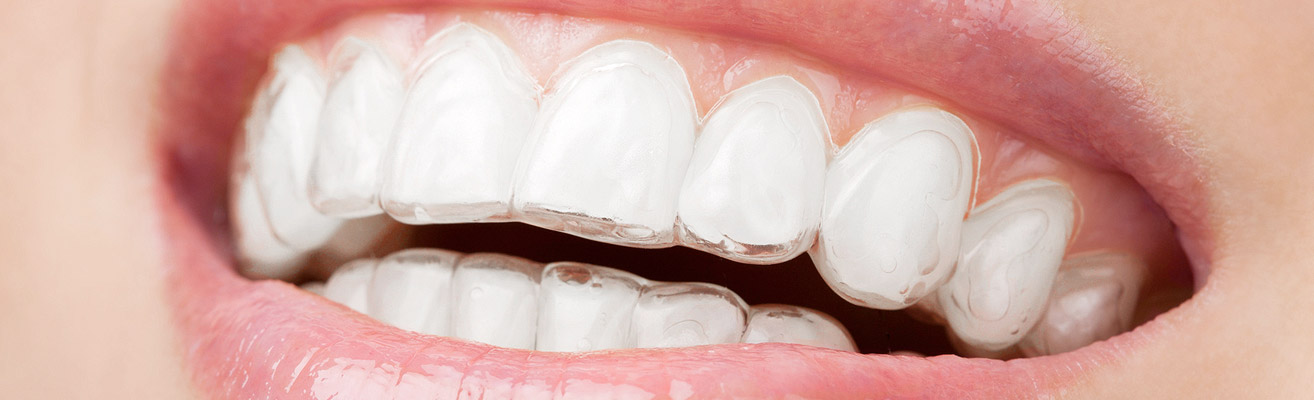 Invisalign Invisible Braces - Best Clear Invisible Aligners