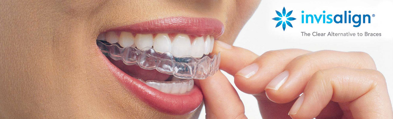 header invisalign