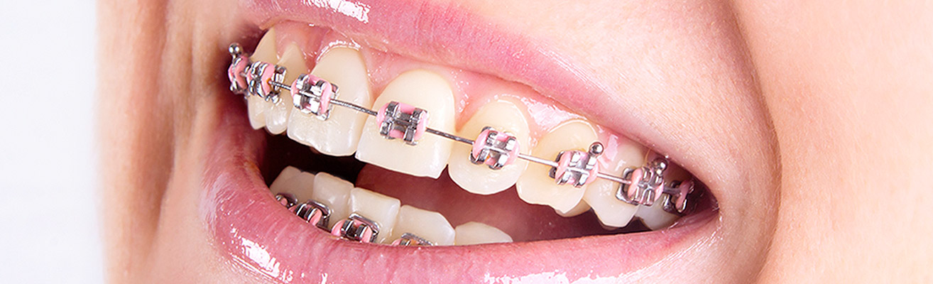 Lingual Braces – Couser Orthodontics