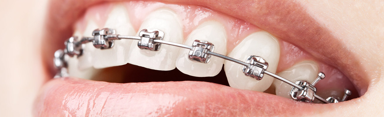 Fixed braces with ceramic brackets hi-res stock photography and