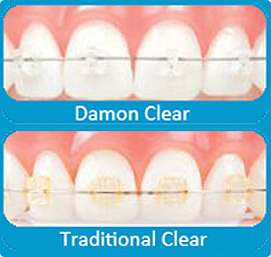 Clear Braces Vs Traditional Braces « Lach Orthodontic Specialists