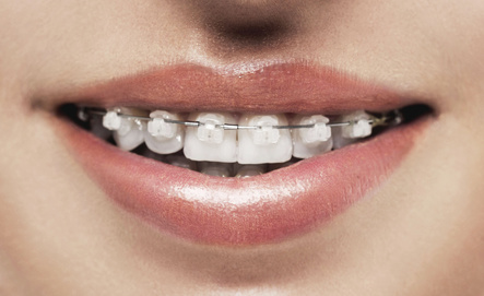 Ceramic Braces - Clear Braces - Compare to Damon Braces System