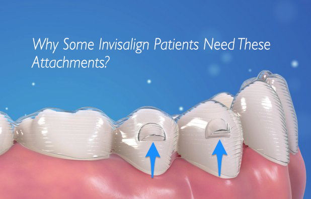 Find Out Why Some Invisalign Users Need Attachments