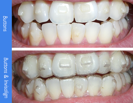 Everything You Need To Know About Attachments With Clear Aligners