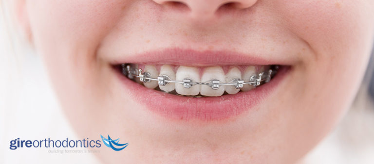 How Long Will Orthodontic Treatment (Braces) Last?