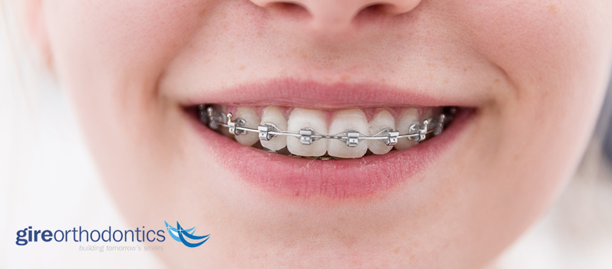 braces dental brace orthodontics teeth wear smile metal faster orthodontic ways springs last treatment pros cons fort worth tx getting