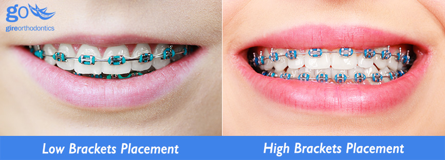 How braces are put on your teeth