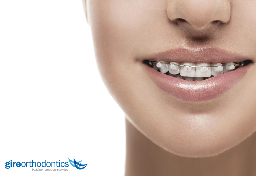 Everything You Need to Know About Ceramic Braces