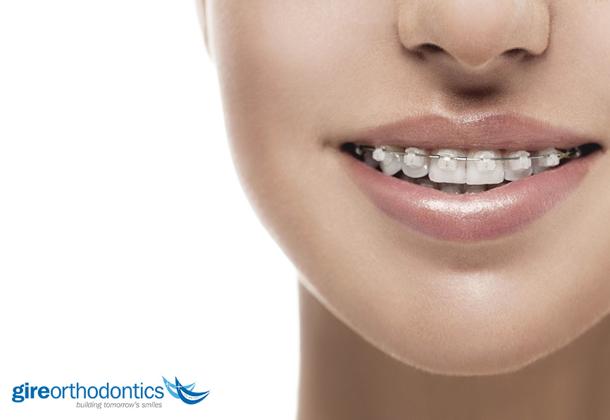 Clear Ceramic Braces – BracesBracesBraces