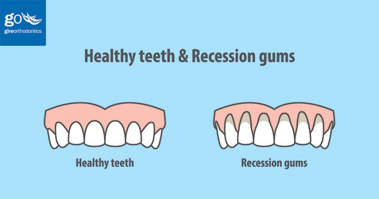 Can Braces Cause Gum Recession? - Gire Orthodontics Chino Hills La ...