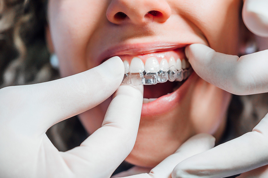 Orthodontics & Clear Aligners