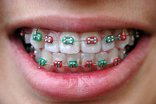 What Role do Elastics (Rubber Bands) Play in Orthodontics? - Gire