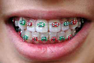 Metal Braces Whittier CA, Traditional Braces Whittier