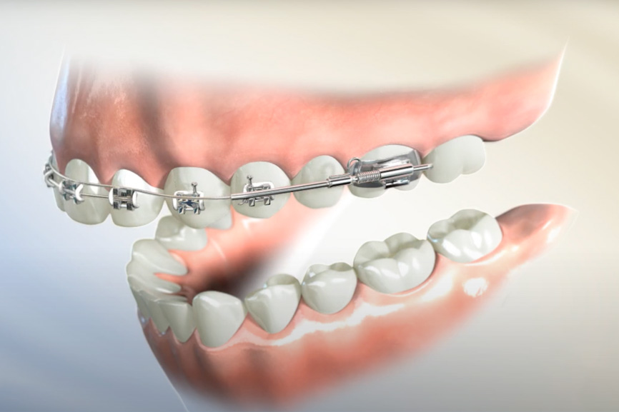 I Only Want Braces on My Top Teeth – Is That Possible? Chino Hills