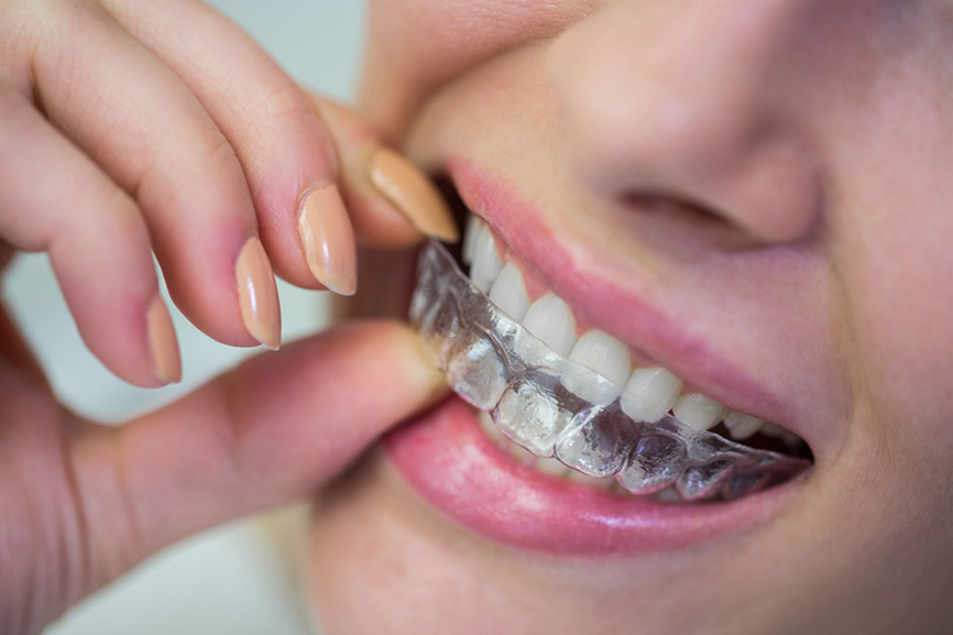 All about invisible braces - Splash Orthodontics