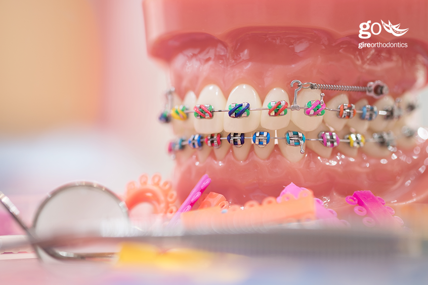 Ask Your North Houston and East Texas Dentist: Should I Get Metal or Clear  Braces?, Element Dental & Orthodontics