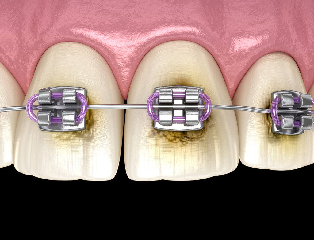 Structure of Braces 1024x785