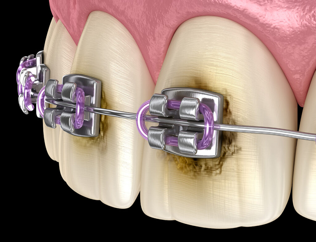 Tartar Buildup 1024x785