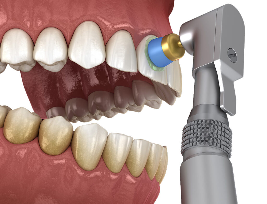 Teeth Remineralization Treatment 1024x785