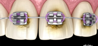 Will Braces Stain My Teeth?